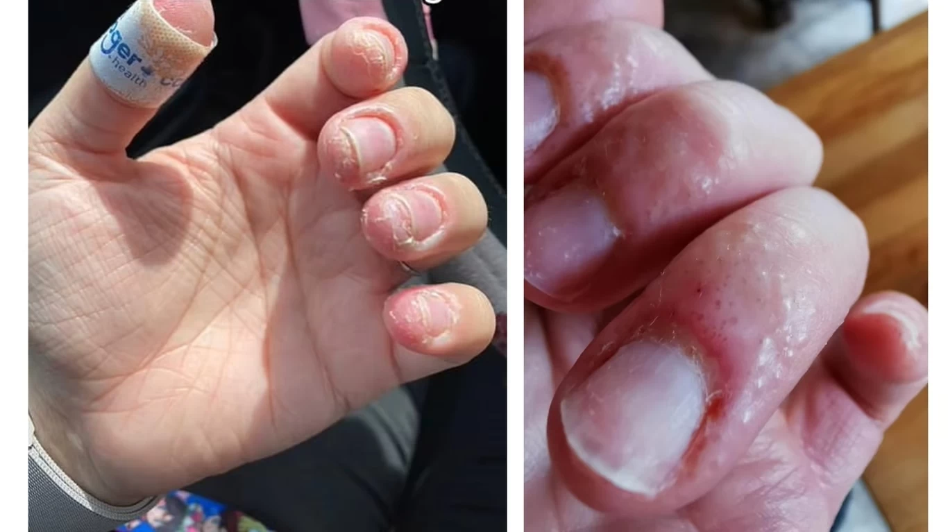 Алергія на гель-лак